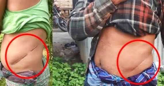 বাংলাদেশে এক কিডনি বিক্রির গ্রাম ‘তারা আমার কিডনি নিয়েছে, আর আমাকে ফেলে গেছে’