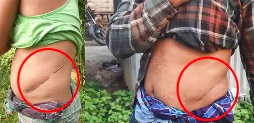 বাংলাদেশে এক কিডনি বিক্রির গ্রাম ‘তারা আমার কিডনি নিয়েছে, আর আমাকে ফেলে গেছে’